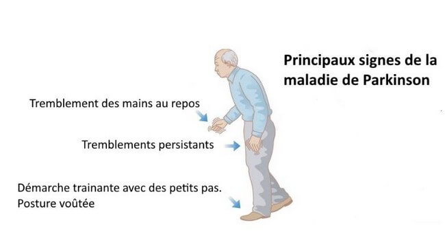 les symptômes de la maladie de Parkinson