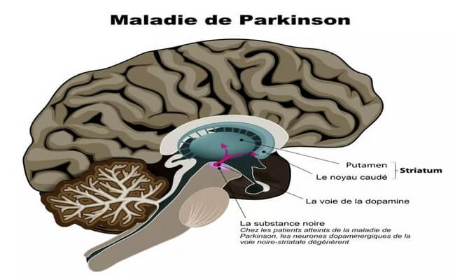 Pathophysiologie de la maladie de Parkinson