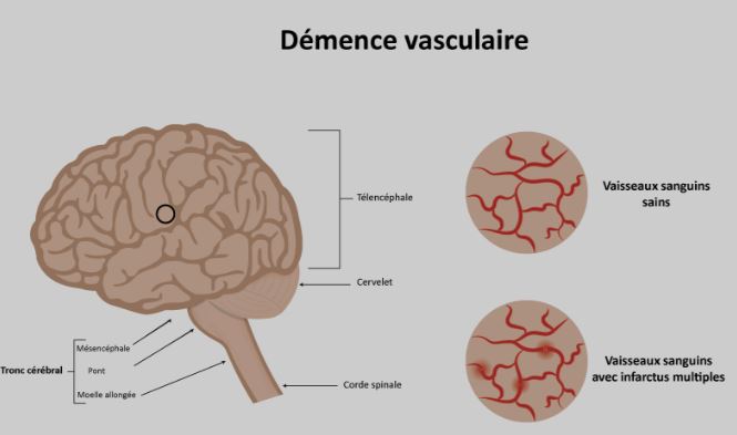 Le Diagnostic de la Démence Vasculaire