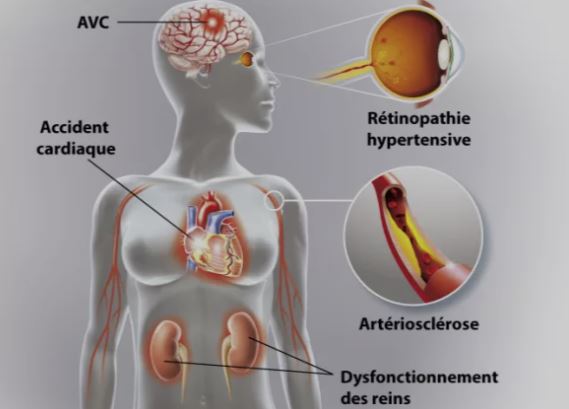 Pourquoi l'HTA est-elle grave