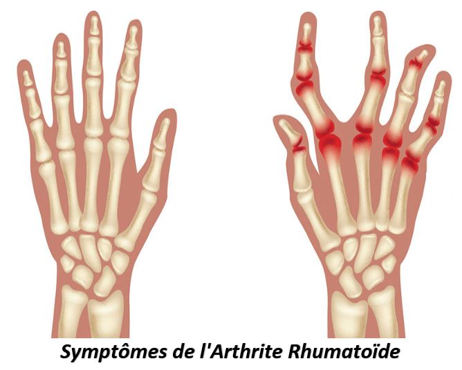 Symptômes de l'Arthrite Rhumatoïde